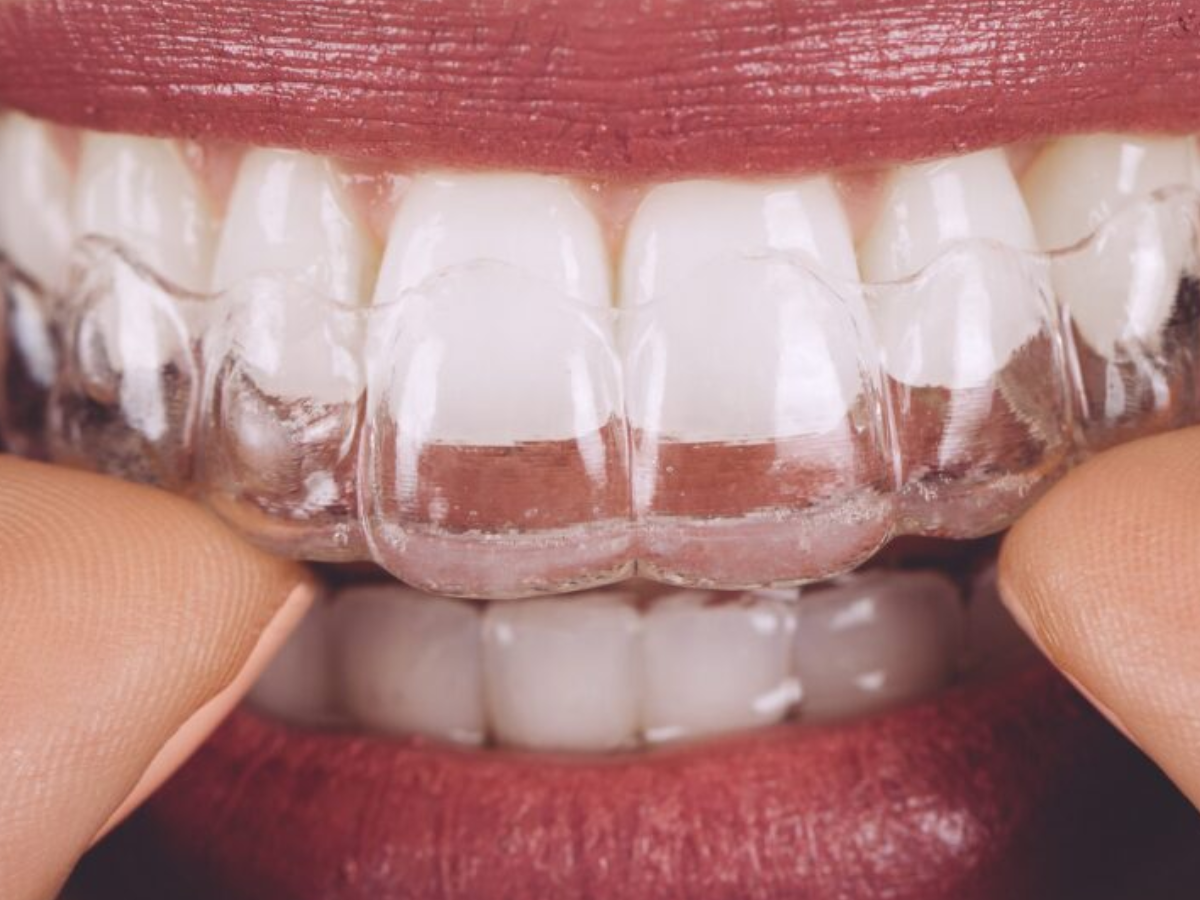 Invisalign: descubra os benefícios do aparelho transparente
