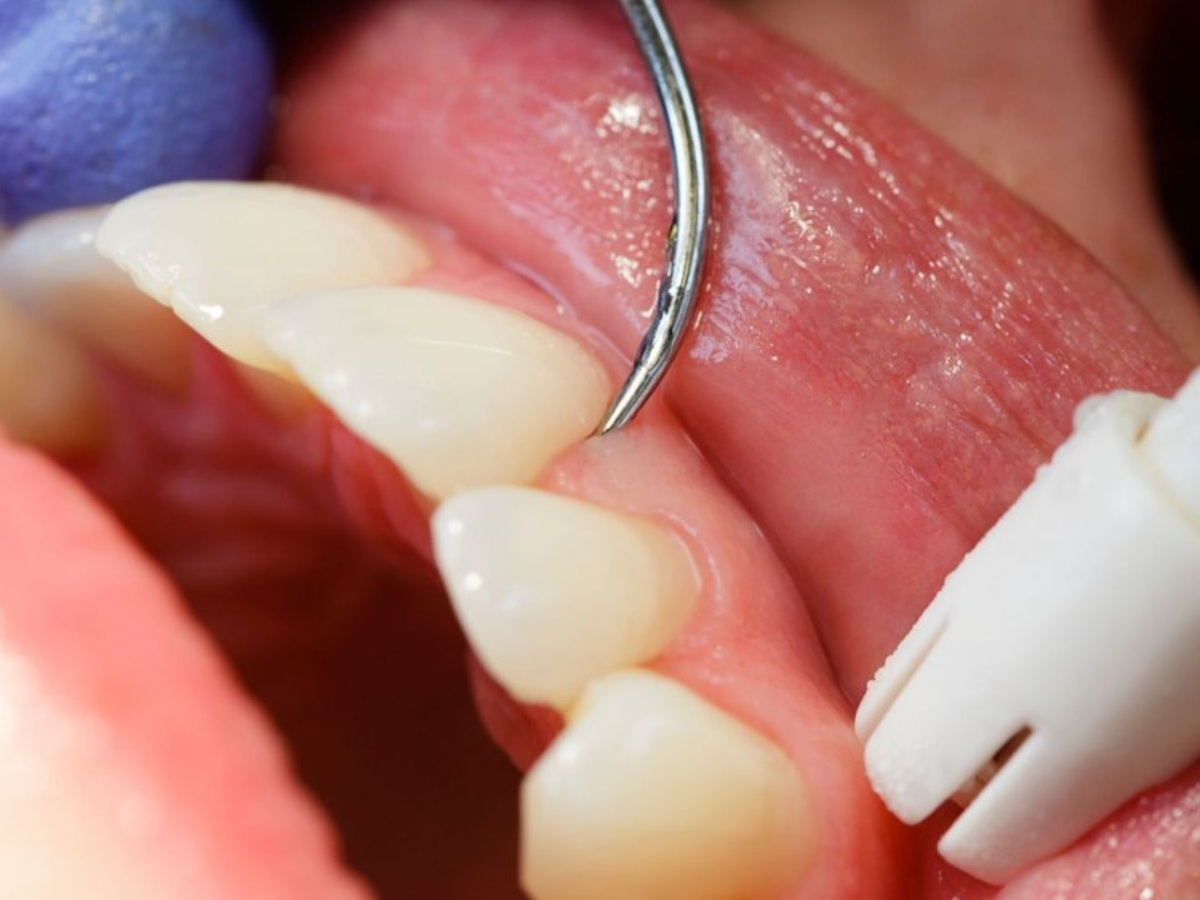 Periodontia: por que cuidar da saúde da gengiva é tão importante?