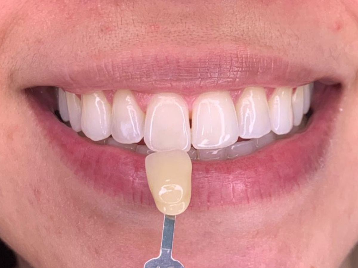Clareamento dental: o que você precisa saber antes de fazer