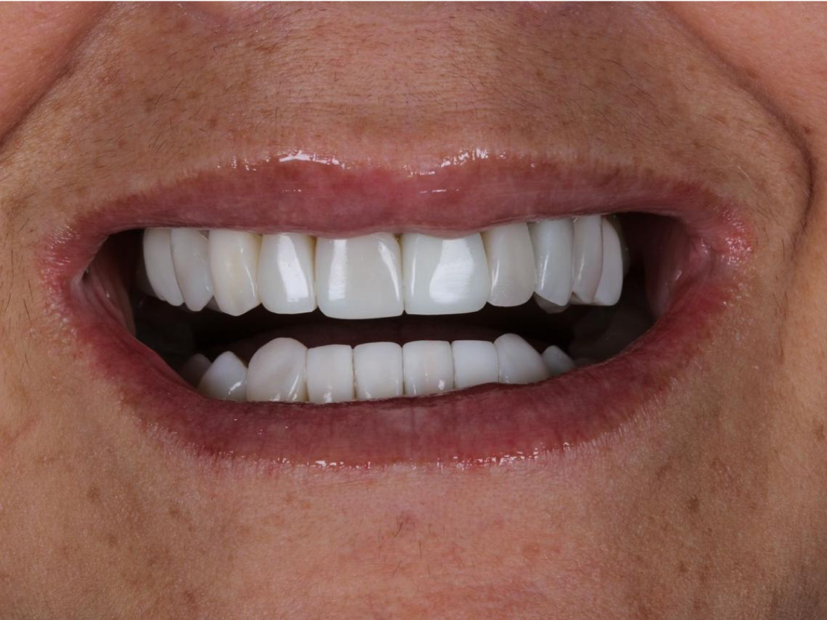 Facetas de resina ou porcelana: qual a melhor escolha para o seu sorriso?
